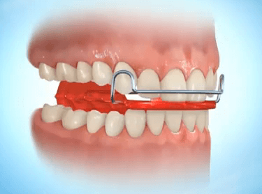 Activator blokbeugel orthodontie