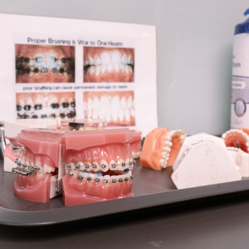 Resultaat orthodontische behandeling Hoofddorp